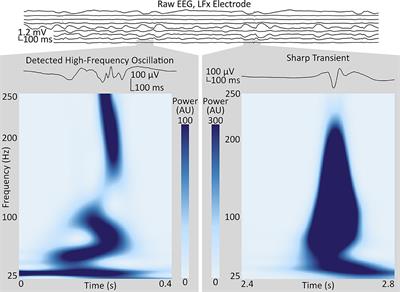 Intracranial EEG Biomarkers for Seizure Lateralization in Rapidly-Bisynchronous Epilepsy After Laser Corpus Callosotomy